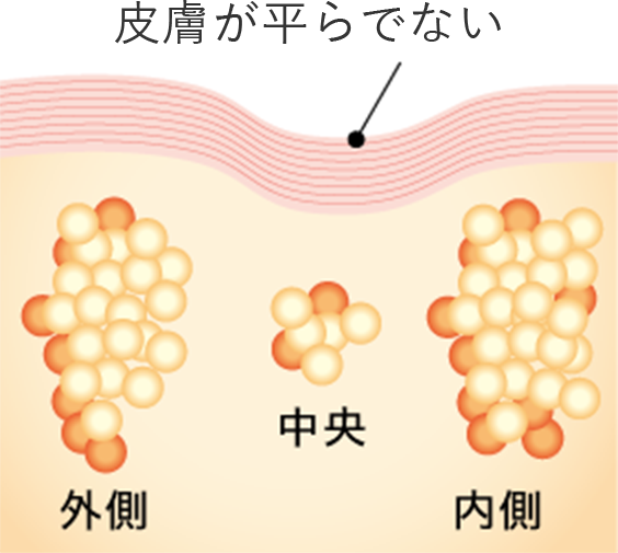 一般的な治療 皮膚が平らでない