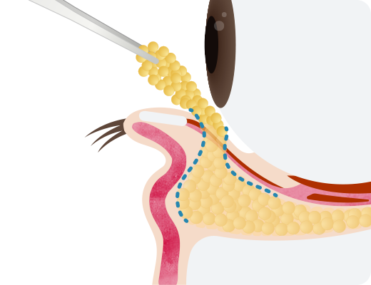 瞼の裏側から脂肪除去